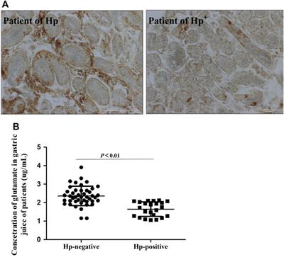 Decreased xCT activity in patients associated with Helicobacter pylori infection